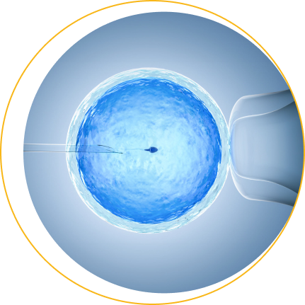 Intrauterine Insemination Using Donor Sperm